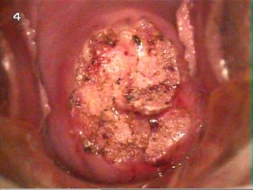 Rahim Ağzı Yarası Belirtileri ve Tedavisi
