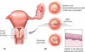 Rahim Ağzı Yetmezliği