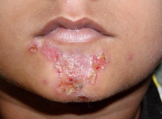 Ağız Yaralarına Bitkisel Çözüm Ağız Yaralarına Bitkisel Çözüm