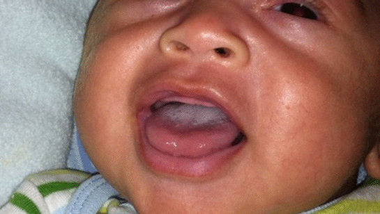 Bebeklerde Ağız Pamukçuğu